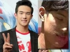 泰星James Ma皮肤过敏 被戏称“麻脸男一号”