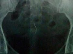 泰女子剖腹产12年后 发现体内竟还留着一根针!